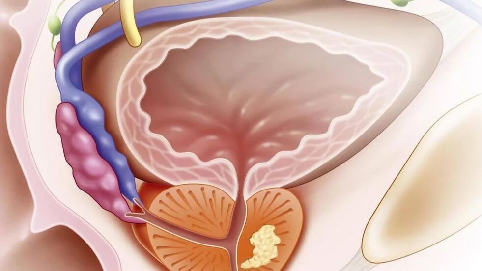 Nebacerial chronic prostatitis