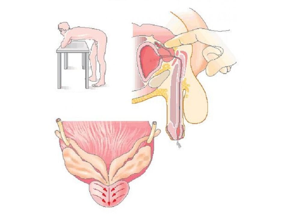 Prostate massage technique by a doctor to perform secretion analysis