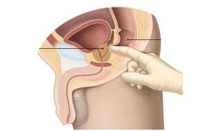 congestive prostatitis discharge