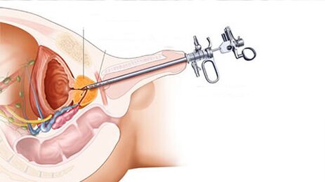 Surgical treatment of prostatitis