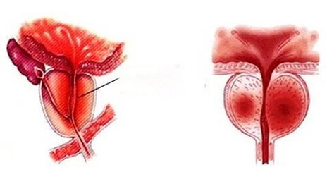 What does chronic prostatitis look like
